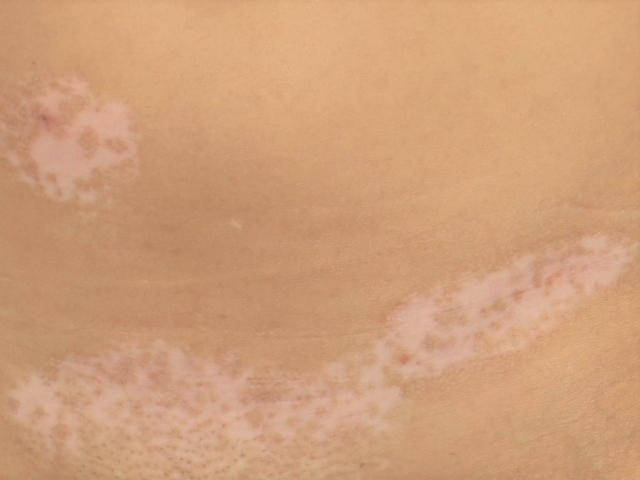 Baltmė(vitiligo)