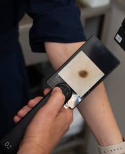 Skaitmeninė dermatoskopija