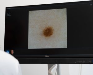 Skaitmeninė dermatoskopija Pošiūno Klinika